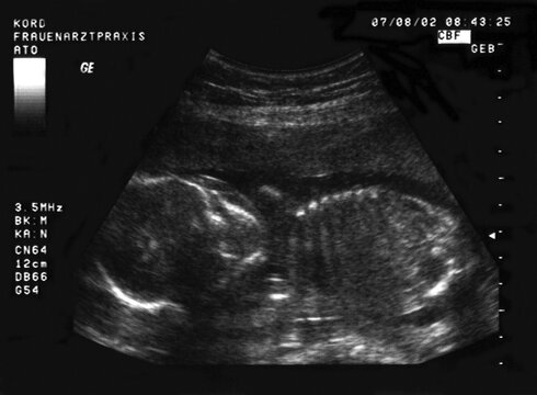 Ultrasound image of a fetus