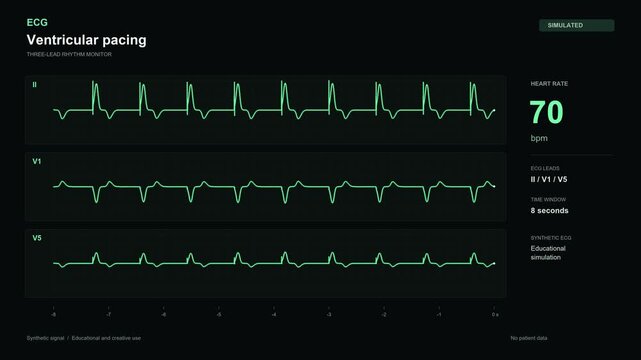 Ventricular pacing ECG monitor simulation on black