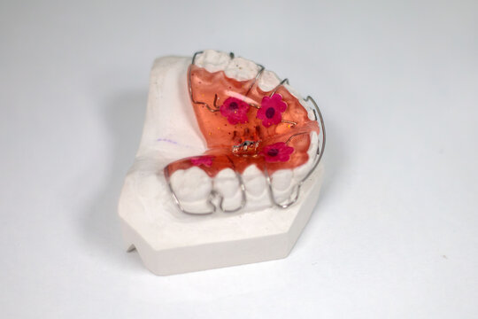 Orange acrylic orthodontic plate with pink dots and a metal wire on a white plaster dental model, dentistry concept of healthy teeth and correct bite, grainy film texture, high quality photo