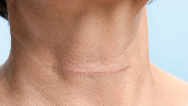 сlose up of a healed horizontal thyroid surgery scar on the front of the neck. Postoperative thyroidectomy scar texture