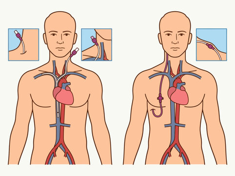 Medical illustration of central venous catheter (CVC) types, showing tunneled and non-tunneled vascular access in the human circulatory system for healthcare education.