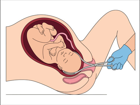 Medical Illustration of Forceps-Assisted Vaginal Delivery During Childbirth