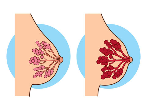Medical Illustration of Female Breast Anatomy Comparing Healthy Mammary Glands and Inflamed Milk Ducts or Mastitis