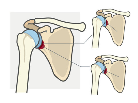 Human Shoulder Joint Anatomy Illustration Highlighting Labrum Injury and Bankart Lesion