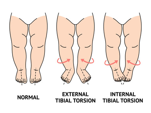 Medical Illustration of Tibial Torsion in Children: Comparison of Normal, External, and Internal Leg Alignment for Pediatric Orthopedics