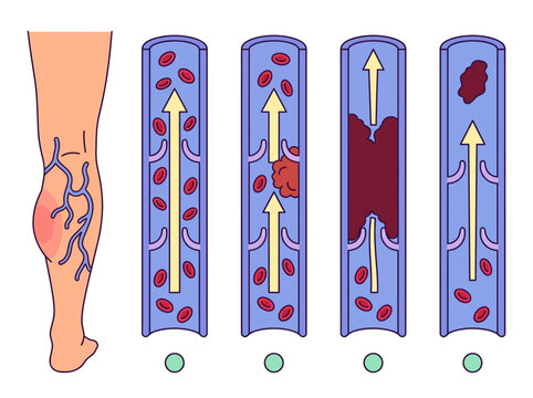 Medical Illustration of Deep Vein Thrombosis (DVT) and Blood Clot Progression in a Human Leg Vein