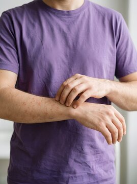 Man scratching his wrist experiencing skin irritation or allergic reaction