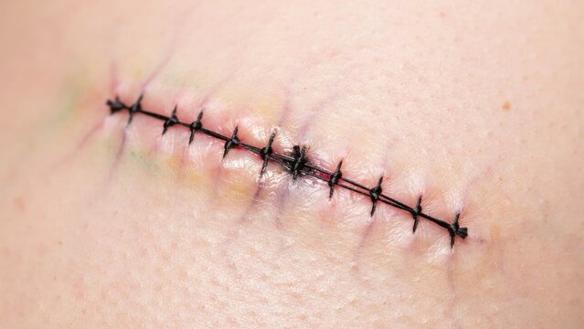 A close-up view of a surgical incision closed with black stitches on human skin. Use for medical recovery and healthcare communication.