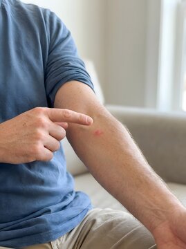 Man pointing to a red itchy rash on his inner forearm with concern