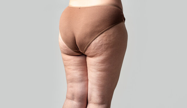 Cellulite on thigh with texture and skin dimples. Dermatology and healthcare for cellulite on thigh. Body shaping and diet for cellulite on thigh. Realistic female legs with cellulite on thigh.