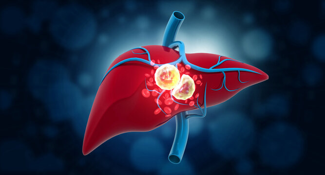Detailed 3D human liver anatomy showing cancer growth, blue scientific visualization, glowing tumor cells, medical pathology concept.