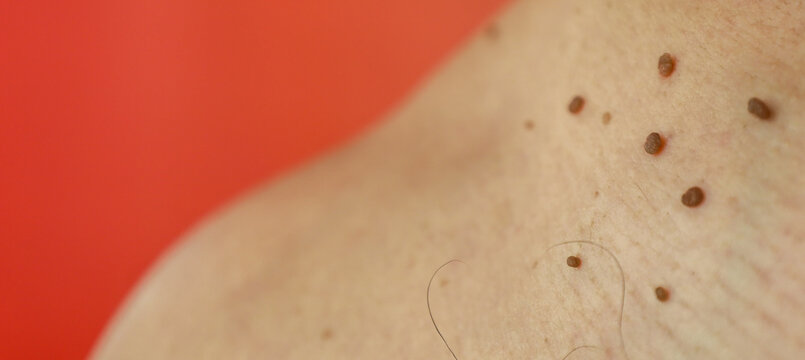 Detailed macro shot of skin with numerous skin tags and moles on a red background. Medical photo shows dermatological growths for health care and skin disease diagnosis themes. 