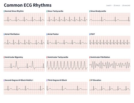 Medically accurate chart of common ECG rhythms and arrhythmias