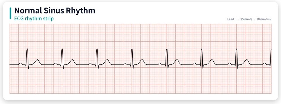 Medically accurate normal sinus rhythm ECG rhythm strip