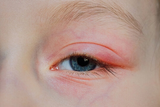 Human blue eye with noticeable redness and swelling on surrounding skin, eyelashes, and signs of an allergic reaction or eye condition. Female blue eye with irritated red skin on eyelids, inflammation