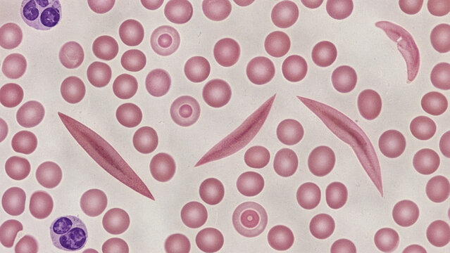 Sickle cell anemia blood smear with sickle and target cells