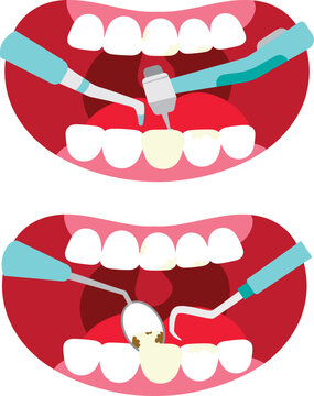 Professional Tooth Cleaning and Dental Care Procedure Illustration