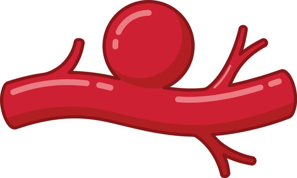 Artery section illustrates the medical condition of a saccular aneurysm within a human blood vessel.