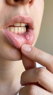 Close-up view of woman showing painful canker sore on inner lower lip with finger pointing to it mouth