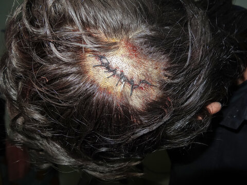Surgical sutures on a human scalp after head injury wound closure, Surgical Incision with Sutures on Scalp