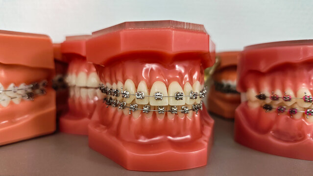 Dental jaw models with metal braces brackets and wires demonstrating orthodontic bite correction indoors on clinic table