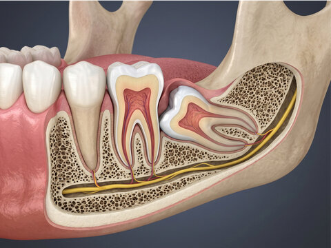 wisdom teeth mesioangular impaction