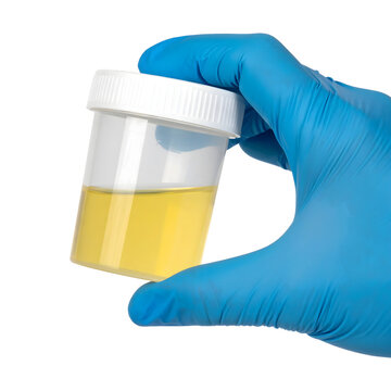 A clear medical urine sample container with a white screw cap, held by a hand in a blue latex glove, isolated on transparent background for clinical laboratory testing and diagnostics.