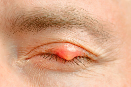 Red inflamed chalazion bump on human closed upper eyelid, skin swelling and eyelid infection in clinical detail. Swollen stye cyst on an upper eyelid. Red hordeolum lump. Selective focus
