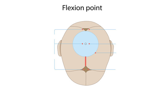  Flexion point , Medical illustration showing the flexion point of the fetal head in a cephalic presentation. The diagram highlights the anatomical reference point on the fetal skull associated 