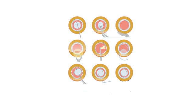 Surgical Steps of Conventional ECCE, A minimalist scientific vector illustration featuring nine circular biological structures arranged in a 3&times;3 grid. Clean, flat design suitable for medical education