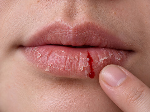 Close up of dry cracked lips with a bleeding split