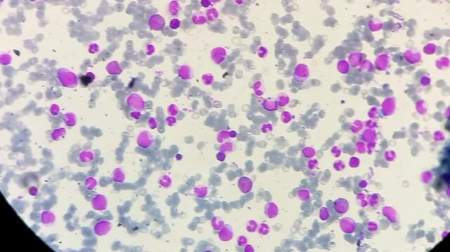 Chronic Myeloid leukemia (Chronic phase). Marked leukocytosis, spectrum of myeloid cells with a predominance of myelocytes, segmented neutrophils, myeloblast (3%) and basophil.