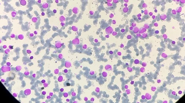 Chronic Myeloid leukemia (Chronic phase). Marked leukocytosis, spectrum of myeloid cells with a predominance of myelocytes, segmented neutrophils, myeloblast (3%) and basophil.