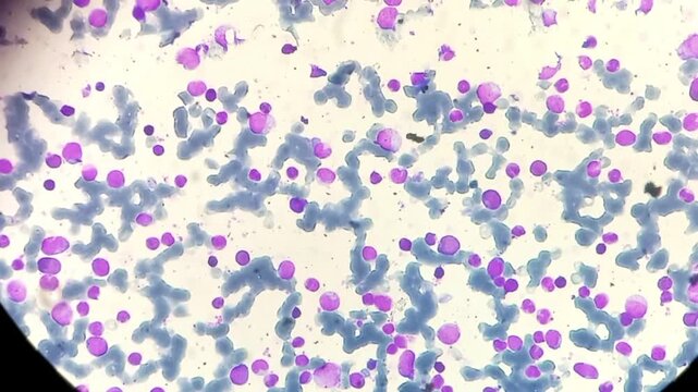 Chronic Myeloid leukemia (Chronic phase). Marked leukocytosis, spectrum of myeloid cells with a predominance of myelocytes, segmented neutrophils, myeloblast (3%) and basophil.