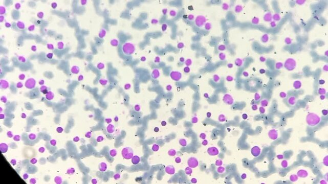 Chronic Myeloid leukemia (Chronic phase). Marked leukocytosis, spectrum of myeloid cells with a predominance of myelocytes, segmented neutrophils, myeloblast (3%) and basophil.