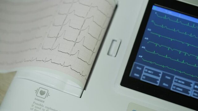 Electrocardiogram Machine Printing Heart Rhythm Graph During Cardio Examination