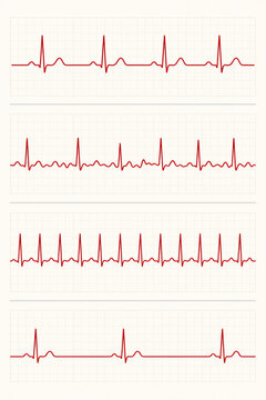 Minimal ECG comparison poster with four red waveform strips showing sinus rhythm, atrial fibrillation, tachycardia and bradycardia on blank grid