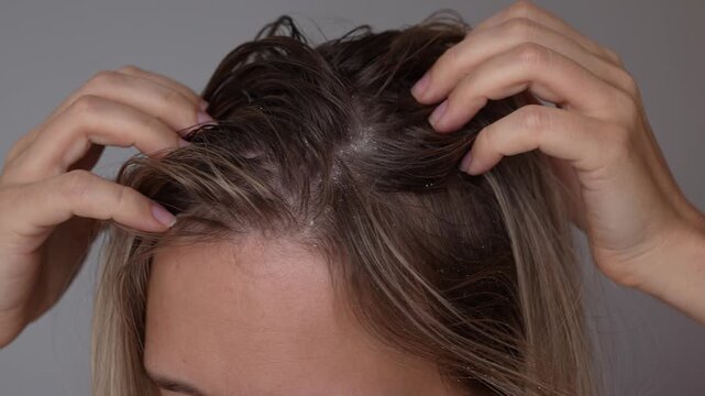 Young blonde woman using her fingers to separate strands of hair, revealing visible white dandruff flakes on her scalp and roots. Closeup of flaky skin, dryness and common scalp problems