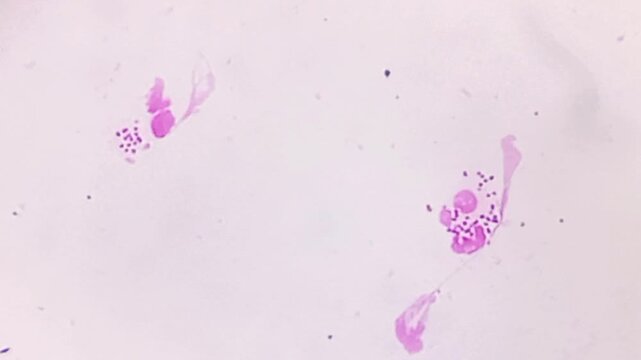 Microscopic footage of urethral smear for Gram stain. Gram negative intra and extracellular diplococci are seen. Neisseria gonorrhoeae bacteria in urethral smear. 