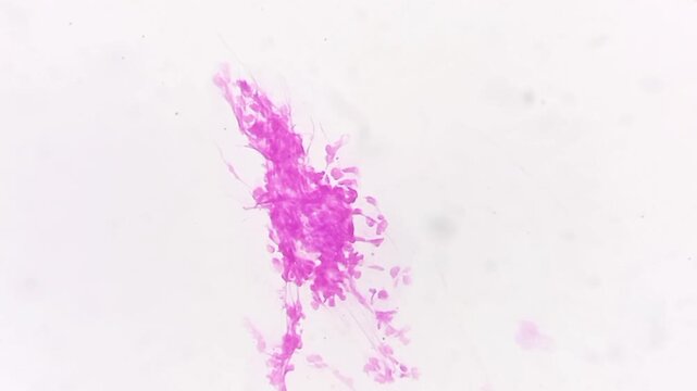 Microscopic footage of urethral smear for Gram stain. Gram negative intra and extracellular diplococci are seen. Neisseria gonorrhoeae bacteria in urethral smear. 