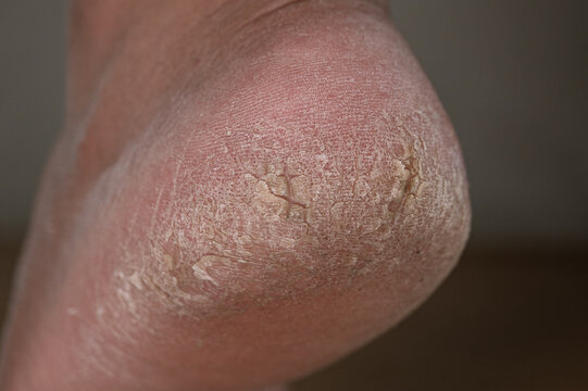 Angled macro of a sun dried heel with chalky flakes and cracked callus against a dark textured background
