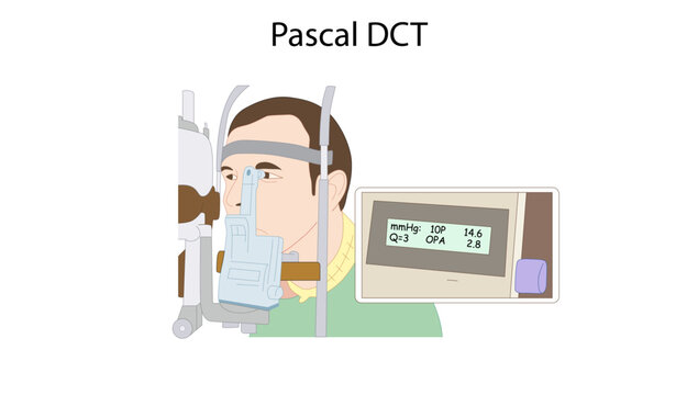 Pascal DCT, Medical illustration depicting a patient undergoing an ophthalmic examination using a Pascal DCT (Dynamic Contour Tonometer) device. The illustration shows the patient positioned at an eye