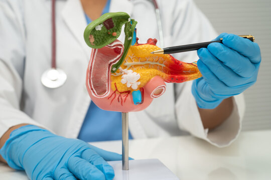 Pancreatitis, pancreatic cancer, Asian doctor with pancreas, gallbladder and bile duct human anatomy model at hospital.