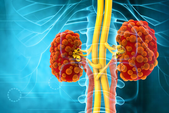 Visual concept of Kidney disease. 3d illustration