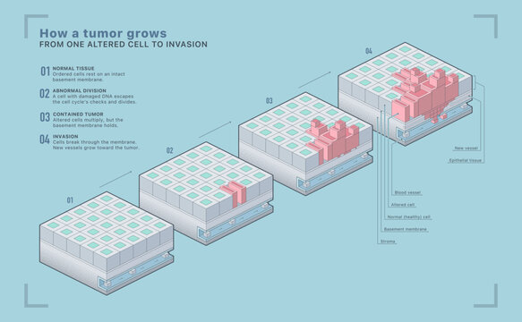Blue isometric infographic of cancer tumor growth stages