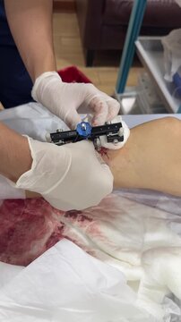Medical professional wraps bandages around a newly installed tibial transverse transport external fixator on a patient's lower leg as part of diabetic foot treatment.