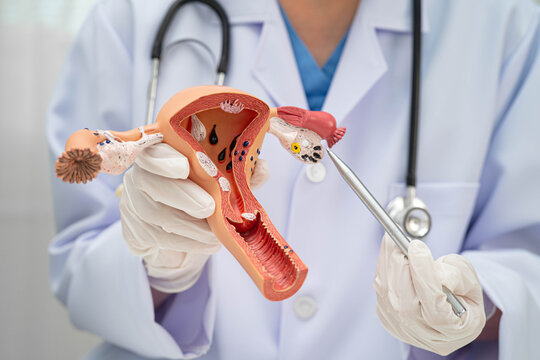 Uterus, doctor holding human anatomy model for study diagnosis and treatment in hospital.