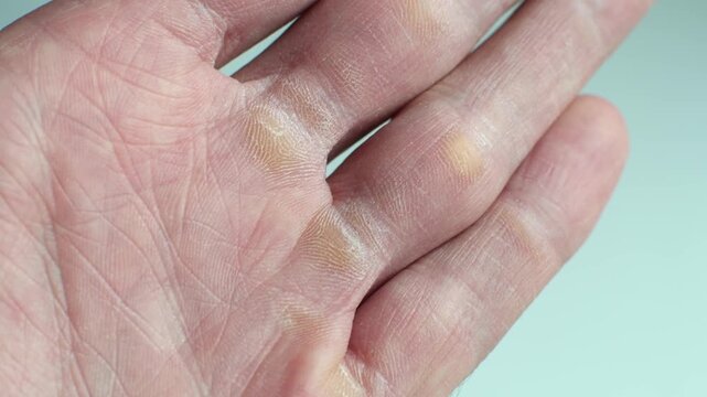 An open palm fills the frame, showing several dry yellowish calluses near the bases of the fingers.