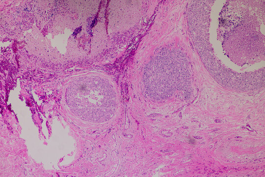 Backgrounds of human cells tissue of lung human under the microscope in pathology lab.View in microscopic of ductal cell carcinoma, adenonocarcinoma from human breast cancer, tissue section by H and E