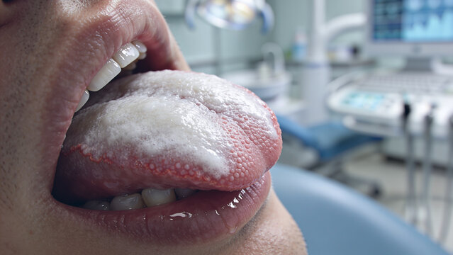 White Coating on Tongue During Oral Health Examination white tongue, tongue coating, oral health, tongue, dental clinic, oral hygiene,